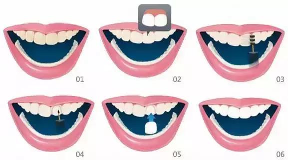 关于牙齿美白你需要知道的哪些事,牙齿美白方法干货分享