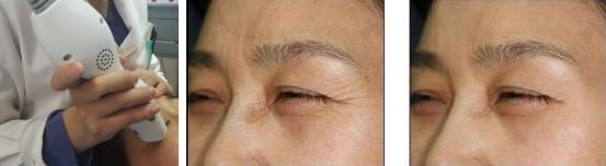 如何去除鱼尾纹的方法图解,鱼尾纹显老的方法