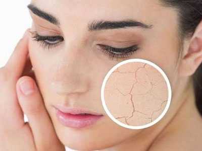 国医草本皲裂膏,中医药治疗皮肤皲裂最新科研医案