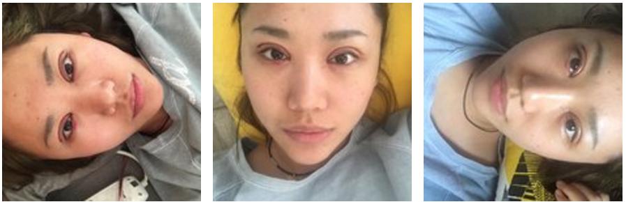 全切双眼皮会不会显老,全切双眼皮显老可以修复年轻吗