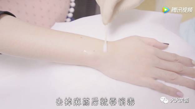 小激光点痣,激光点痣全过程视频