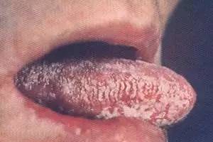 喝茶可以预防口腔癌吗,口腔癌术后怎么预防复发