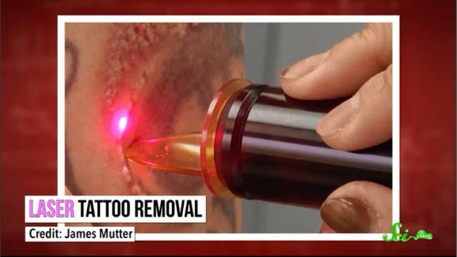 现在怎么去除纹身,怎么才可以去除纹身