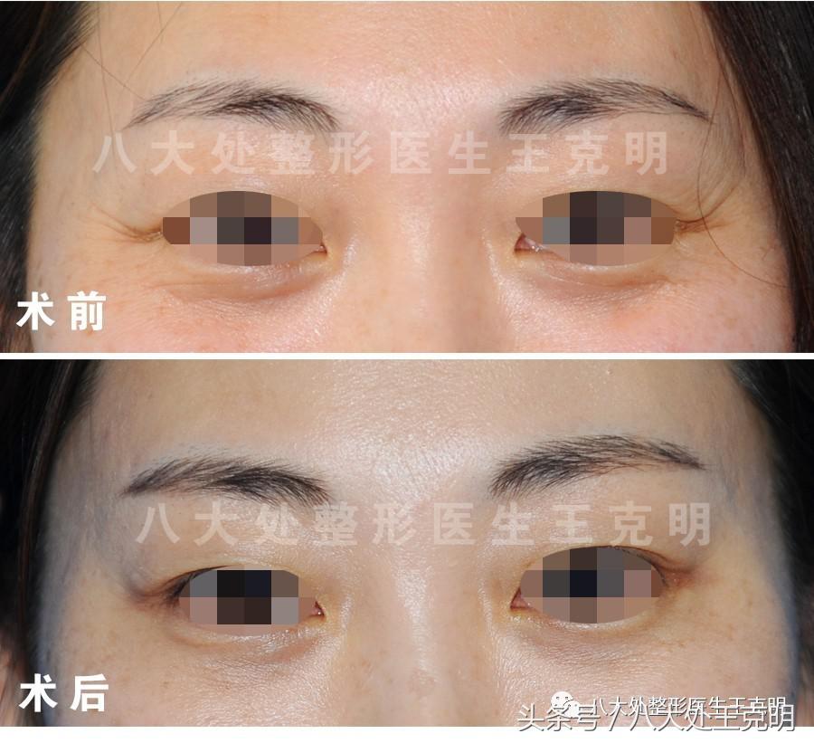 高低眉眼睛怎么改善,高低眉最简单的恢复方法