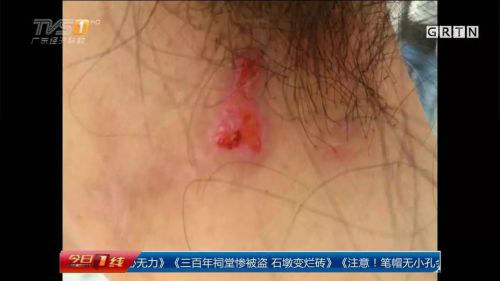 恐怖！深圳女子烫发直喊痛竟是药水腐蚀了皮肤