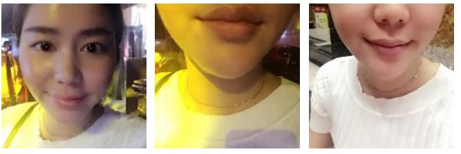 玻尿酸丰唇即刻效果,玻尿酸丰唇有几种唇型