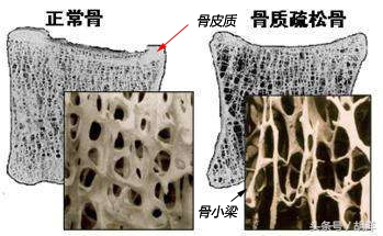 肋骨骨折咳嗽可以打骨质疏松药吗,咳嗽把肋骨咳骨折是什么原因