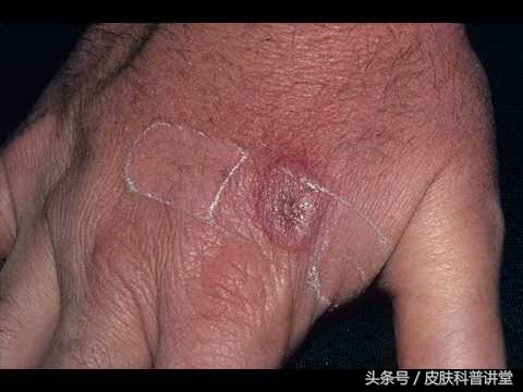 有没有被猫抓过,那你可要留意一下这个皮肤病了,猫抓病