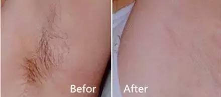 不要轻易的尝试脱毛,脱毛时大家都在做什么