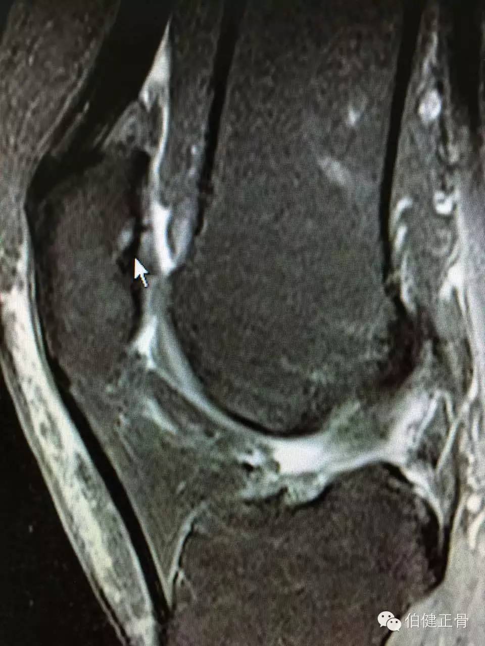 髌骨软化症怎么治疗效果好,髌骨软化症膝盖疼怎么治疗
