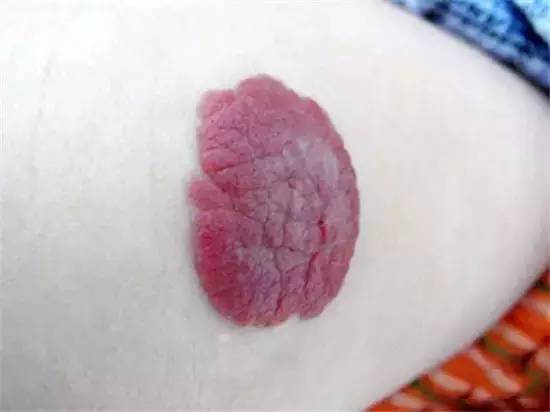 哪些胎记有危险,宝宝胎记是什么原因造成的