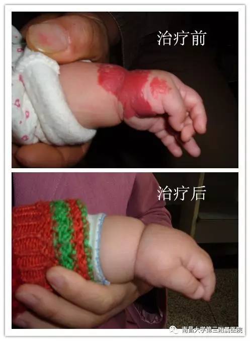 哪些胎记有危险,宝宝胎记是什么原因造成的