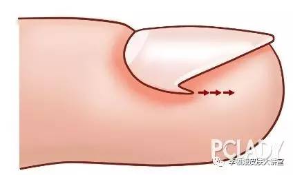 嵌甲自己剪出来就好了吗,嵌甲能修脚吗