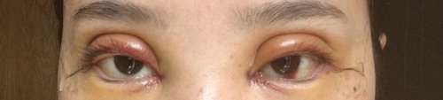 全切双眼皮疤痕增生多久可以恢复,全切双眼皮恢复过程经历真实