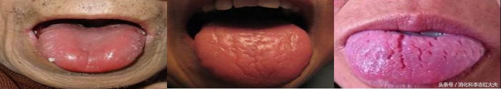 反流食管炎加萎缩性胃炎中医治疗,反流性食管炎中医把脉能看出来吗