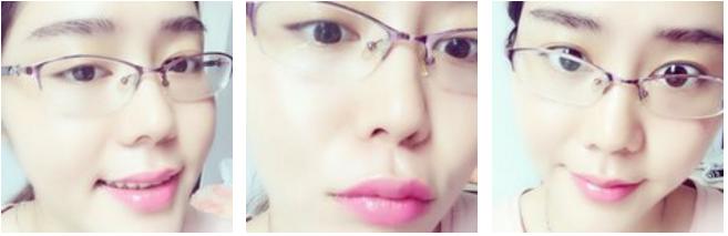 玻尿酸丰唇即刻效果,玻尿酸丰唇有几种唇型