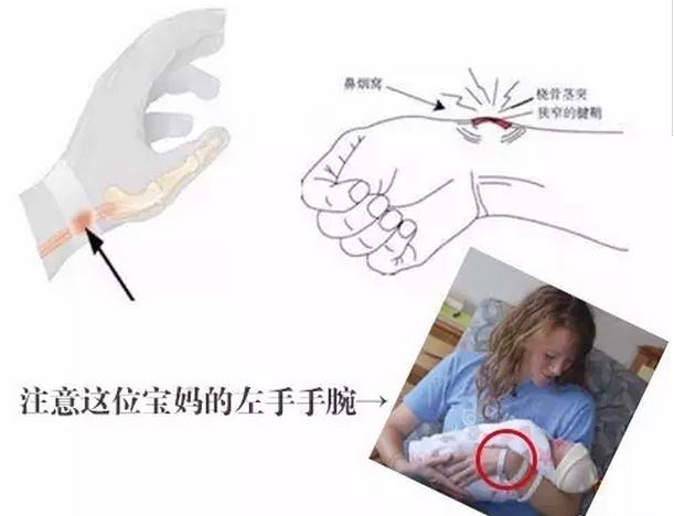 经常抱孩子的家长手腕酸胀可能是患了腱鞘炎，怎么正确抱孩子？