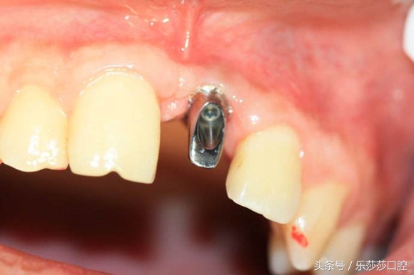 种植牙到底有多痛苦,种植牙真实经历详细全部过程