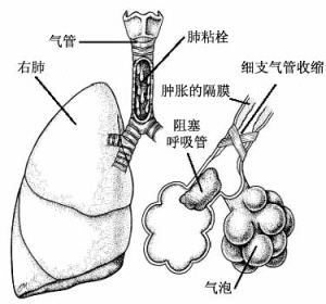 慢性支气管炎的最好偏方,慢性支气管炎小偏方