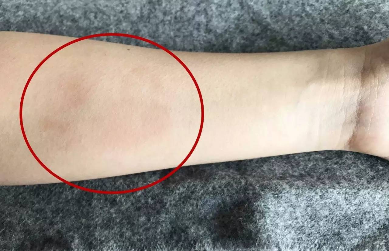 压疮的五大误区,压疮最新指南解读是哪一年的