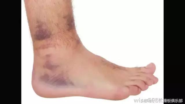 怎么快速恢复崴伤的脚踝,如何彻底治愈脚踝陈旧性扭伤