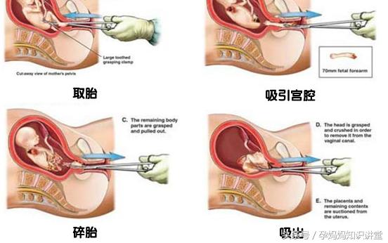 孕妇怀孕28周该注意什么,怀孕28周什么情况才能引产