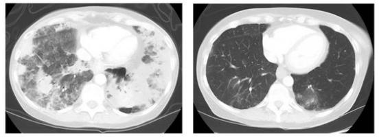 关于癌症你一定要知道的事,肺癌家属应该知道哪些问题