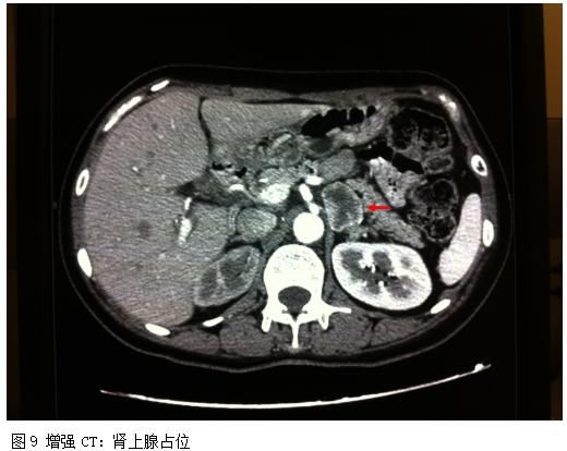 心前区疼痛、憋闷、咽部有紧缩感，伴出汗、呕吐可能是什么病？