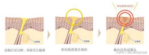 毛孔问题解决方法视频,烫伤后毛孔变大会恢复正常吗