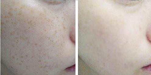 祛斑效果最好的祛斑方法,祛斑的有效方法红霉素软膏祛斑