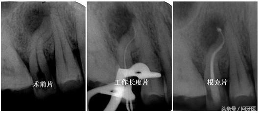 杀牙神经后不治疗了可以吗,杀牙神经不补牙可以吗