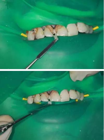 可乐牙治疗实拍,可乐牙治疗好前后图片