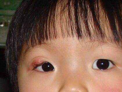 麦粒肿反复可能是癌症,孩子长麦粒肿怎么办