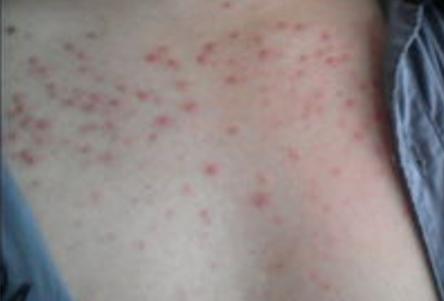 胸前长了很多红色的点点用什么药,胸前长小点点
