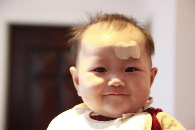 宝宝摔肿了怎么消肿最快的速度,宝宝摔破皮肿了怎么办