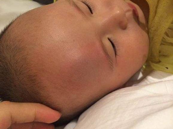 宝宝摔肿了怎么消肿最快的速度,宝宝摔破皮肿了怎么办