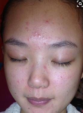 胸前长了很多红色的点点用什么药,胸前长小点点