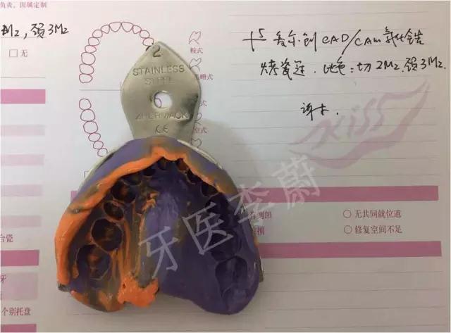 前牙残根桩冠修复,前磨牙嵌体修复