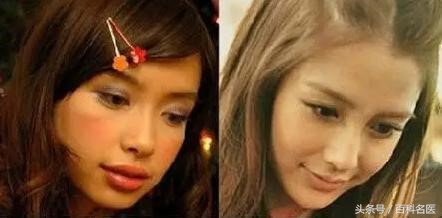 四种人矫正牙齿脸型变化是最大的,牙齿畸形矫正图片大全