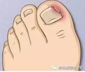 嵌甲自己剪出来就好了吗,嵌甲能修脚吗