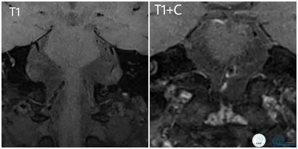 天坛周记|右椎动脉V1段及V4-基底动脉串联病变支架治疗一例