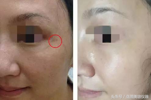 皮秒激光操作视频过程,皮秒为什么会反黑