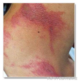 隐翅虫皮炎部位睡觉需要避开吗,晚上睡觉怎么避免隐翅虫