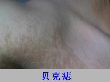 什么是贝克痣？治疗应注意什么？