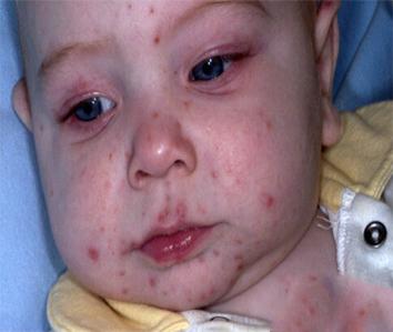 宝宝得奶癣怎么治,宝宝奶癣反反复复有什么办法