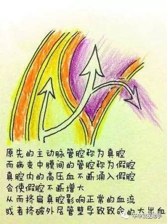 a型主动脉夹层是什么原因引起的,主动脉夹层b型支架对寿命的影响