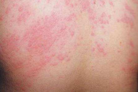 对灰尘过敏怎么改善体质,怎么改善湿疹引起的过敏的体质