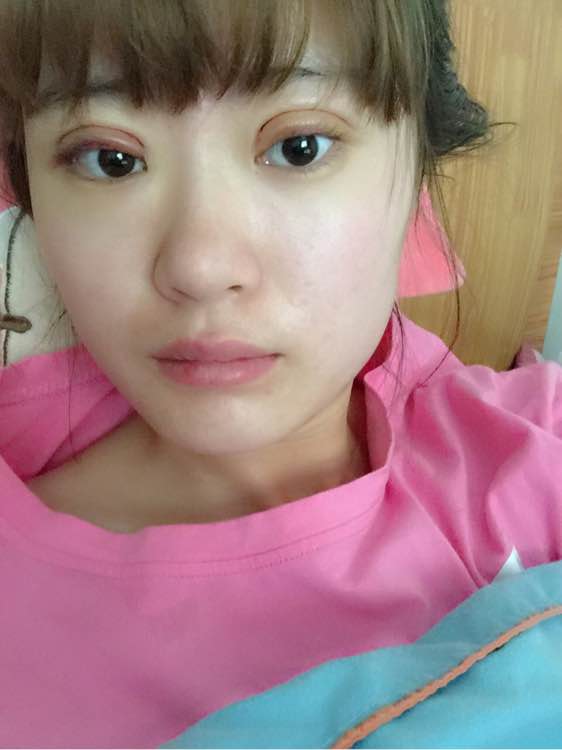 全切双眼皮一个月还是肿怎么回事,全切双眼皮一个月还肿是怎么回事