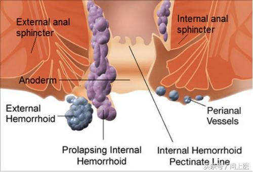 肛肠疾病你到底了解多少,痔疮知识自测