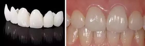 大名“根管治疗”，小名“抽神经”，诊疗要求：全冠保护